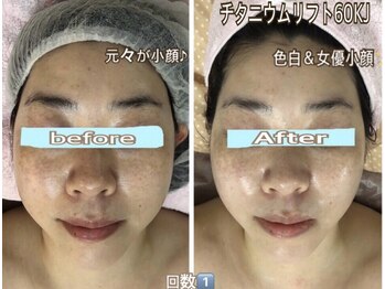 アルページュ(Arpege)/小顔＆色白革命チタニウム♪