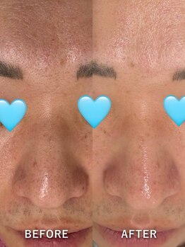 ベルミーランド MEGAドン・キホーテ草加/毛穴ケアBefore→After