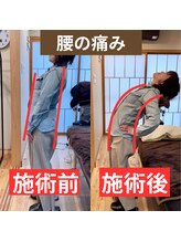 鍼灸整骨院ゼット(Z)/腰痛の施術後の変化