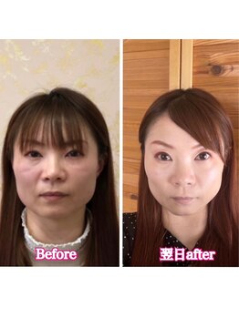 フレル(FUREL)/私もコンプレックスがあったから