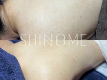 シノノメ(SHINONOME)/＊背中ニキビケア
