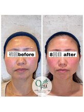 キュープ 相模原淵野辺店(Qpu)/たった4回で人生で1番小さな顔に