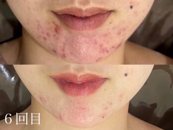 ホワイトアクア 四日市店(WHITE AQUA)/毛穴改善ハーブピーリング