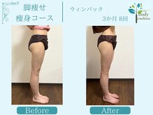 ボディコンディション/ウィンバック/痩身/小顔毛穴洗浄