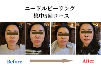 望月整体院/マイクロニードルピーリング集中