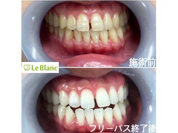ルブラン 奈良店(Le Blanc)/歯も美白ケアを！！