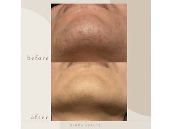 リモアボーテ(RIMOA beaute)/施術メニュー　ヒゲ脱毛