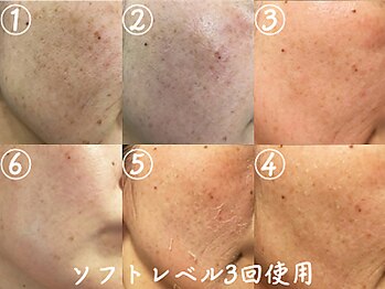 クレアナ ザ ビューティー(KULEANA the beauty)/ハーブピーリング