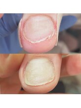 セラキュアネイル(Theracure nail)/足の爪のむしり癖の緩和