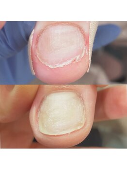 セラキュアネイル(Theracure nail)/足の爪のむしり癖の緩和
