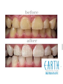 ホワイトニングサロン アース 福知山店(EARTH)/Before&After美白ホワイトニング
