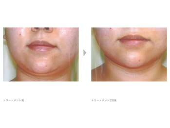 Nビューティー/最新RFサーモシェイプオーパス