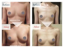 PMK ルグラン 難波店(Le Grand)/バストケア施術前後比まとめ