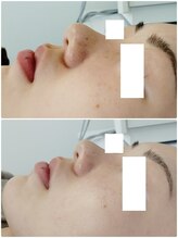 ビーユー(Be.you)/毛穴洗浄×プラズマ