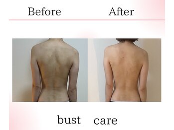 サロンツキ(salon tuki)/バストケア症例