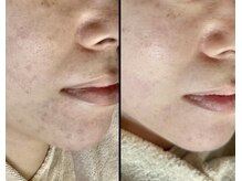 ニキビ・肌荒れにはプラズマ！！