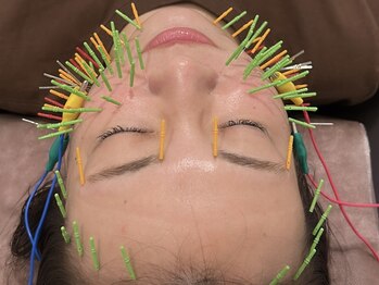 ソラナ(Solana)/美容鍼【100本】百華鍼