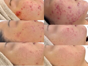 ニコレ(Nicore)/赤みニキビ・ニキビ・跡