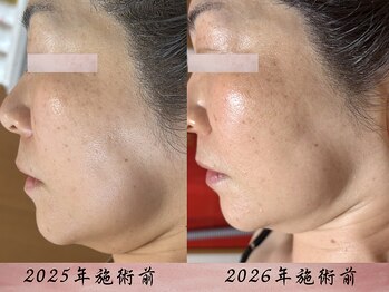 サロン ド エン(Salon de. en)/50代タルミケアハーブピーリング