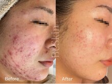 ビースキン 藤沢店(BeSkin)/DT有無選べるハーブピーリング