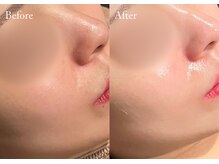 シューラディアント(ShuRadiant)/セラピール