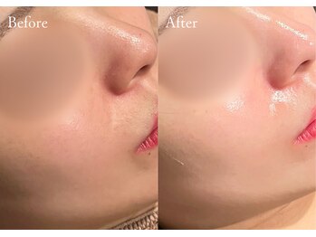 シューラディアント(ShuRadiant)/セラピール