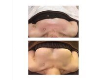 ベルビューティー(belle beauty)/【バストの左右差悩み症例】