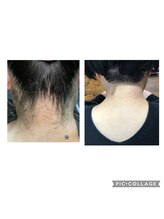 サロンシャイン(Salon Shine)/うなじ部分にも照射◆うなじ美人