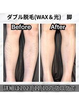 エスポワール(Espoir)/脚脱毛　その場で爽快感UP！