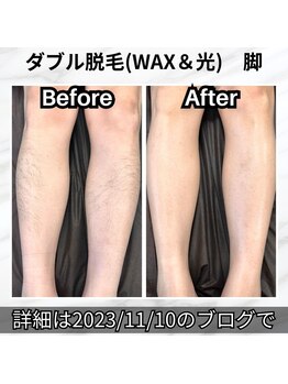 エスポワール(Espoir)/脚脱毛 その場で爽快感UP!