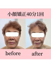 ルアージュ 狭間店/リフティング小顔矯正♪