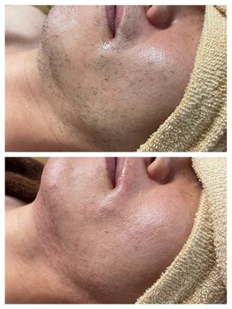 はだころも/メンズ ヒゲ 光脱毛　