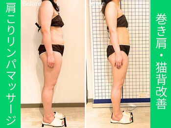 ミモザ鍼サロン(mimoza鍼サロン)/巻き肩・猫背改善