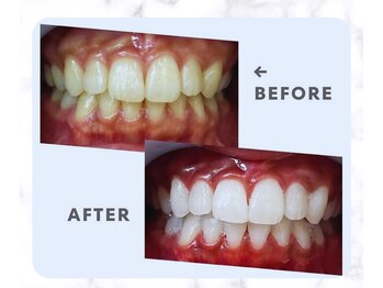 スマイルホワイト 赤羽店/★お客様ビフォーアフター★