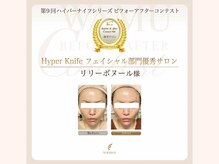 リリー ボヌール(Lily bonheur)/Before&After Contest