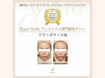 リリー ボヌール(Lily bonheur)/Before&After Contest