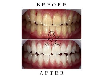 ジュエルホワイトニング/ホワイトニングビフォーアフター