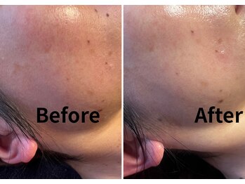 ルアーナ(Luana)/ハーブピーリング