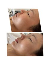 エルブラン(Herb ame)/ブラックピーリング×小顔施術