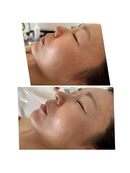 エルブラン(Herb ame)/ブラックピーリング×小顔施術