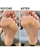 クオッカ(Quokka)/たこ・魚の目ケア