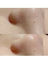 マイフェアレディ 今池(MyFairLady)/毛穴洗浄ハイドロフェイシャル