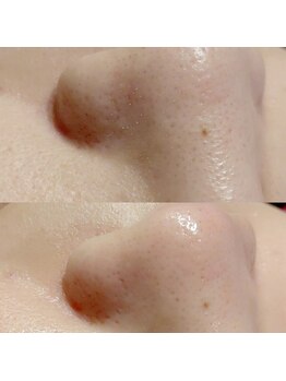 マイフェアレディ 今池(MyFairLady)/毛穴洗浄ハイドロフェイシャル