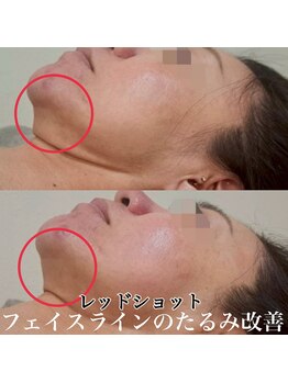 アンドエス 六本木(and S.)/フェイスラインのもたつきに！