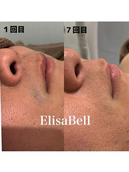 エリーザベル(Elisa Bell)/男性ヒゲ脱毛途中経過