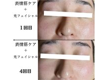 ラーナ(Lana)/光フェイシャル＋表情筋ケア