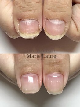 マリーロール 梅田店(Marie Laure)/自爪育成/深爪矯正/ネイルケア