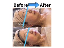 ラシェリー(La Cherie)/ビフォーアフター