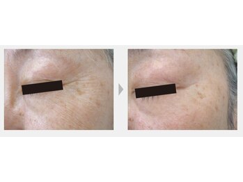 Nビューティー/最新RFサーモシェイプオーパス