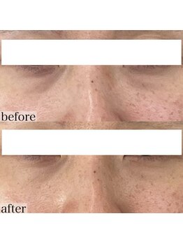 ヴェルシック(Belchic)/ここまで小さいクマも改善可能